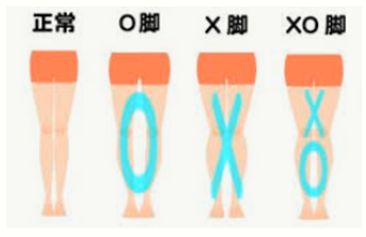 原因 x 脚 【O脚・X脚・XO脚】あなたの脚はどのタイプ？膝の痛みは足の形にあるかも！